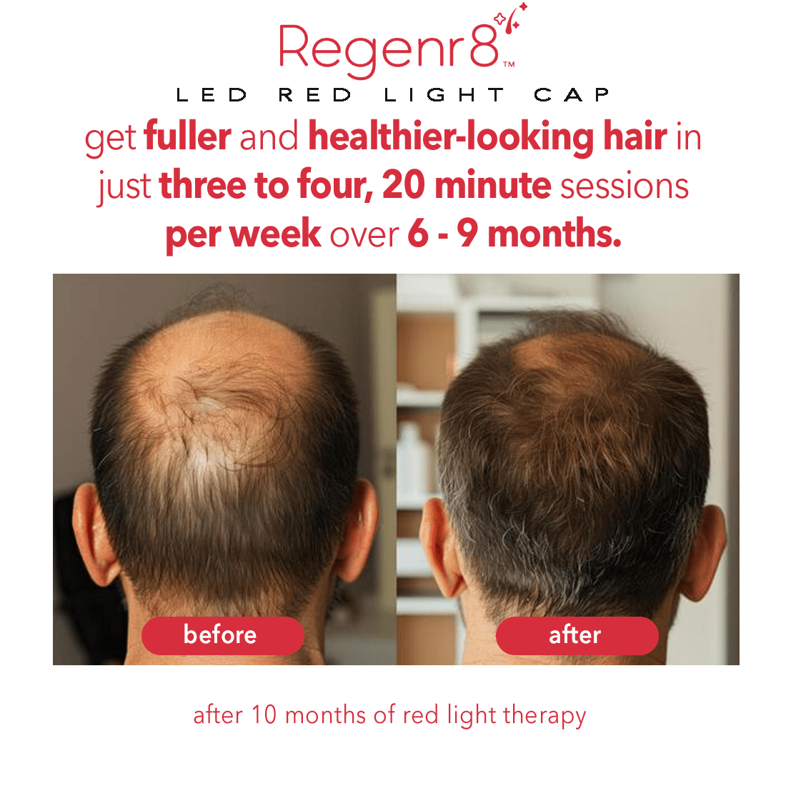 Regener8™ - LED Red Light Therapy Cap for Hair Regrowth - AURELUX BEAUTY