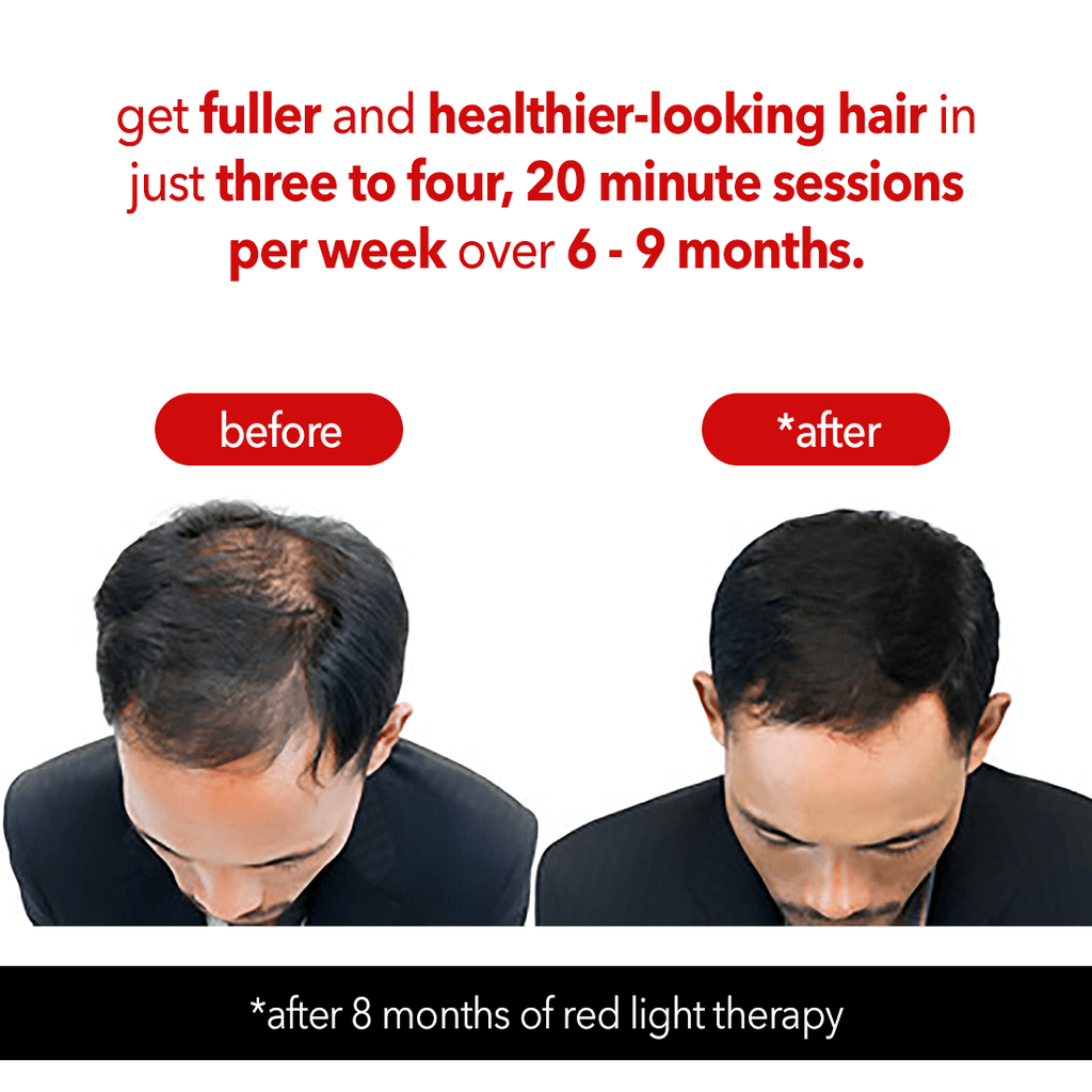 Regenr8™ Pro - 272 Laser Red Light Therapy Cap for Hair Growth (Black) - The Red Light Store