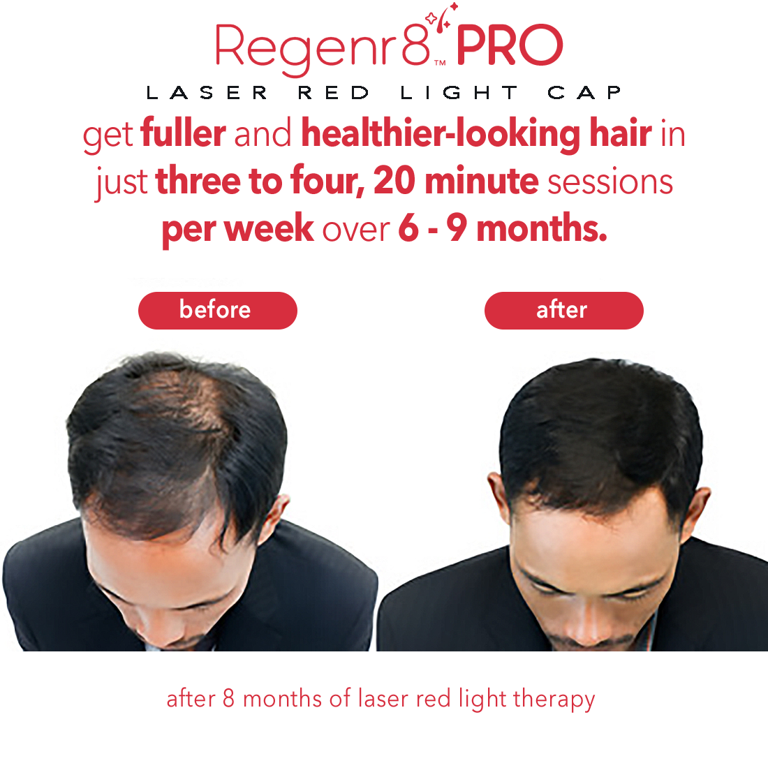 Regenr8™ Pro - 272 Laser Red Light Therapy Cap for Hair Growth (Black)